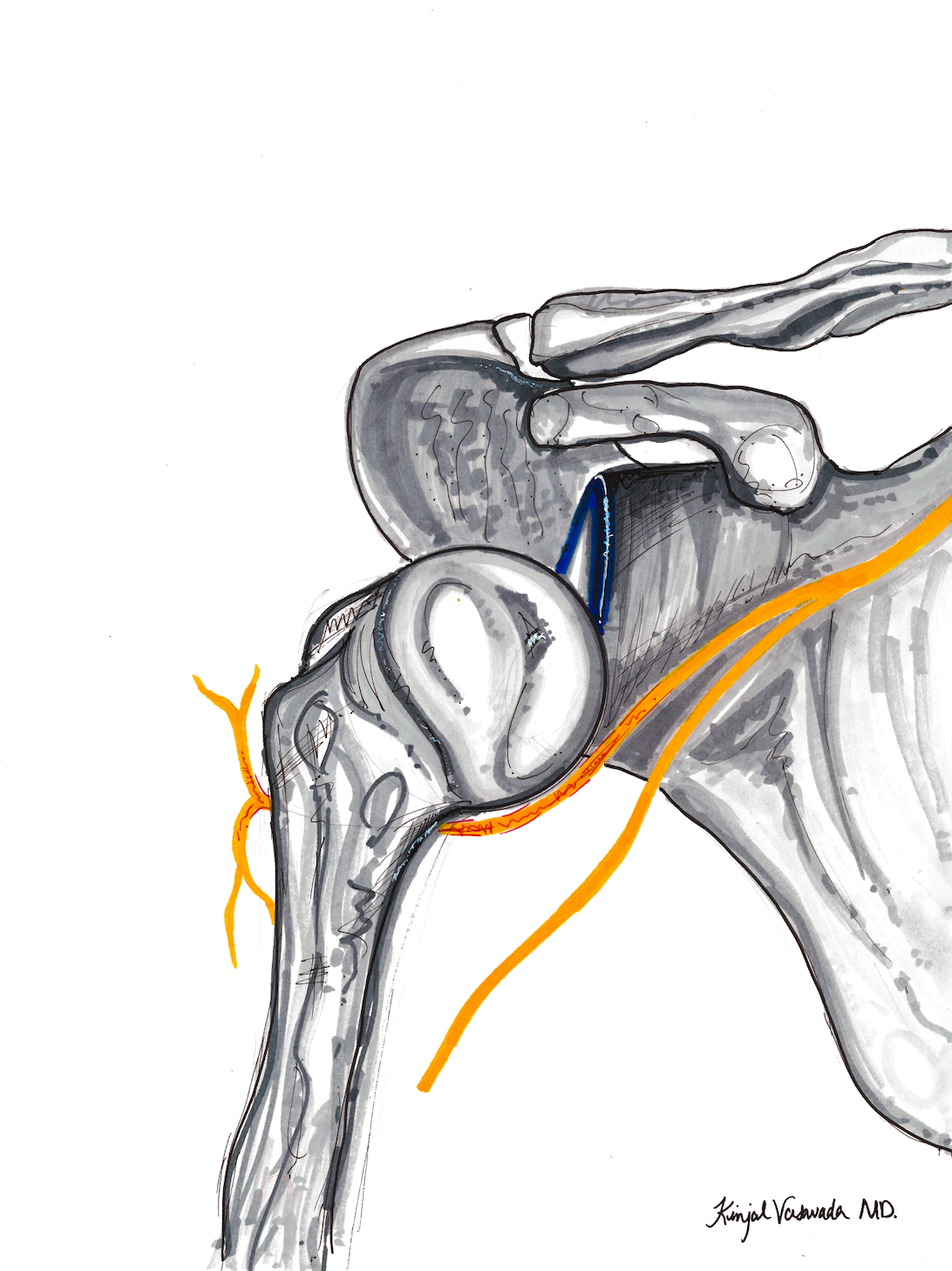 Axillary Nerve Neurapraxia
