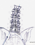 Endovascular Anuerysm Repair of the Aorta (EVAR)