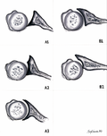 Glenoid B+C Type Wear