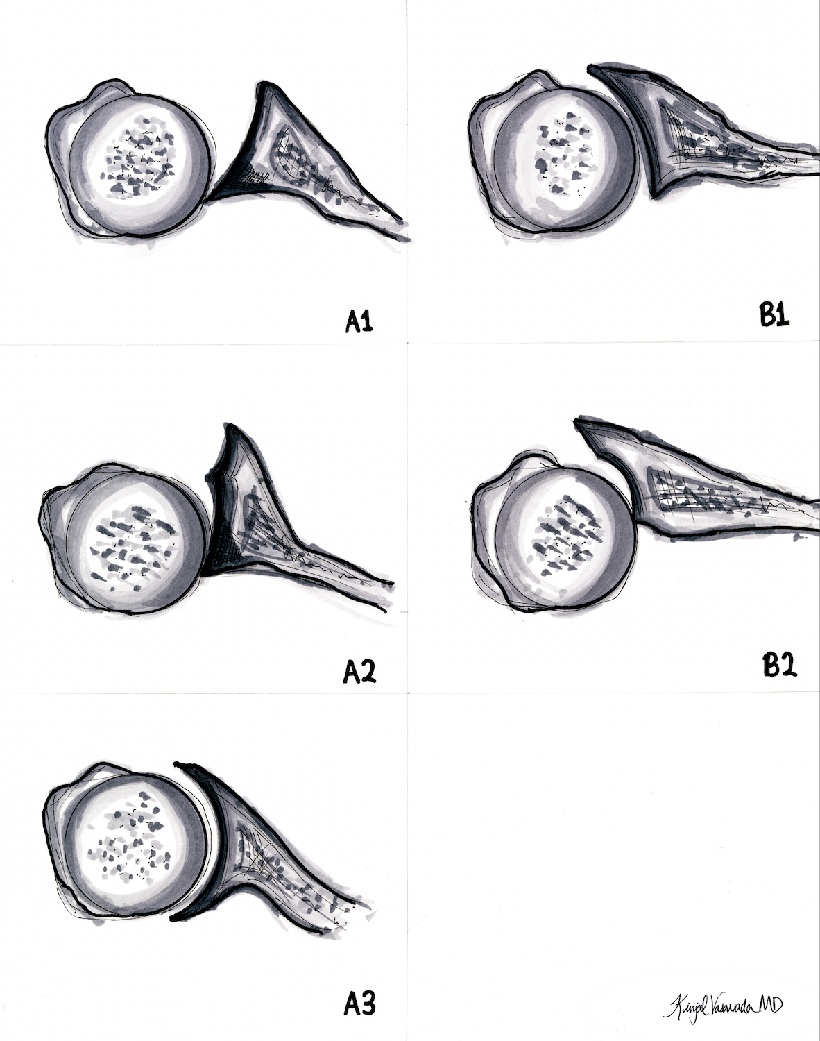 Glenoid B+C Type Wear
