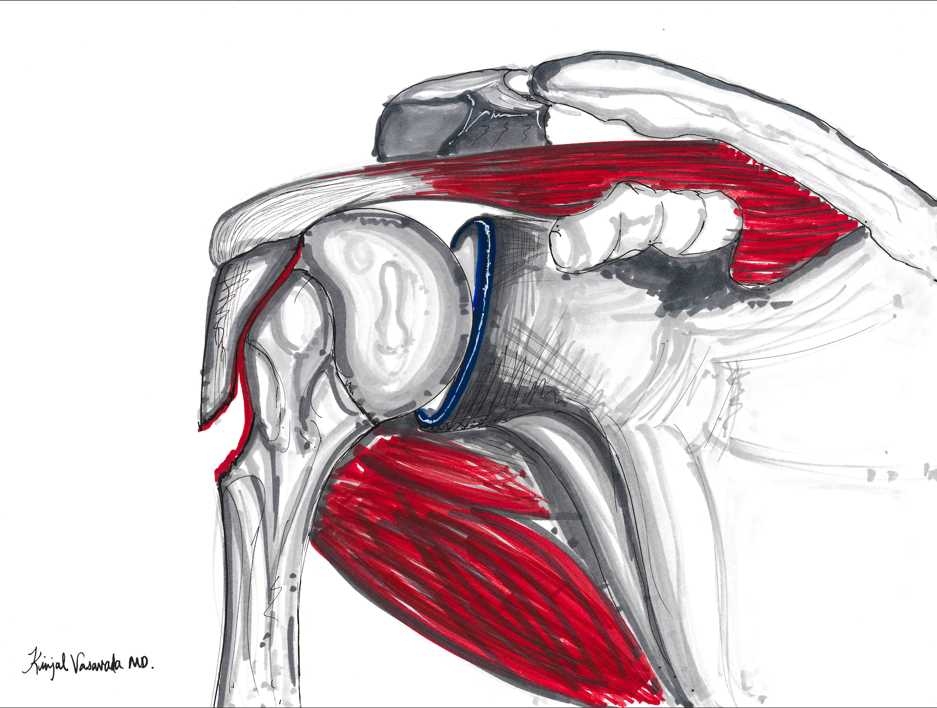 Greater Tuberosity Fracture