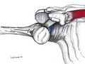 Rotator Cuff Tear