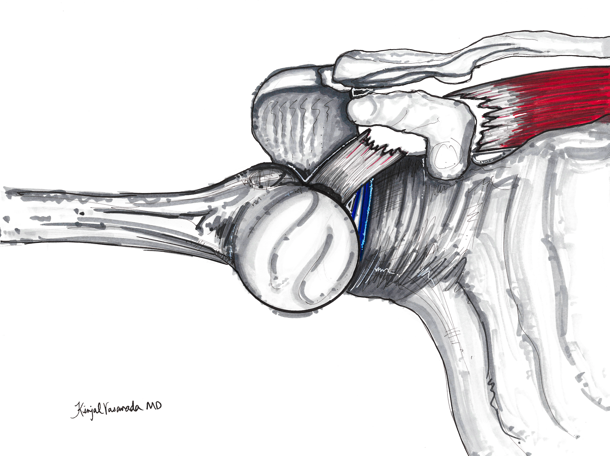 Rotator Cuff Tear