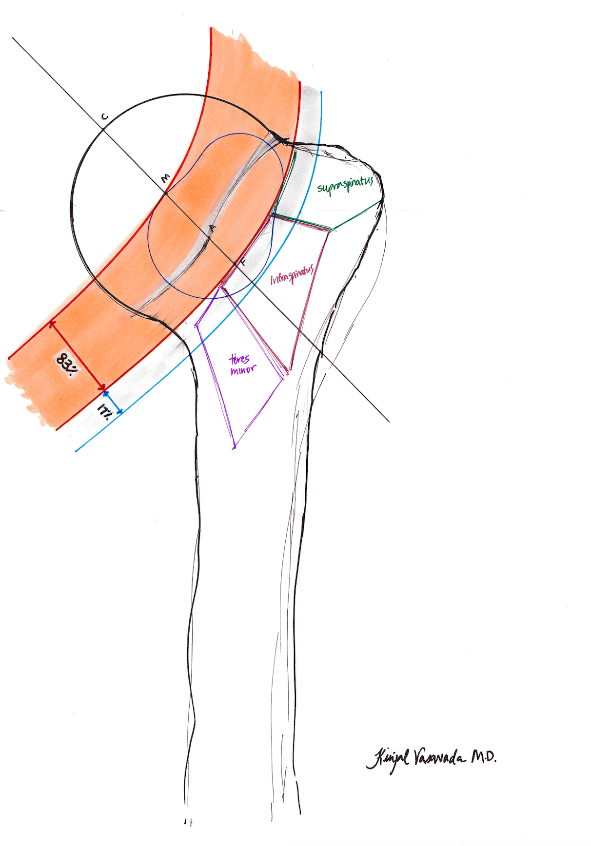 Glenoid Track Definition