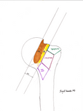 Hill-Sachs Interval
