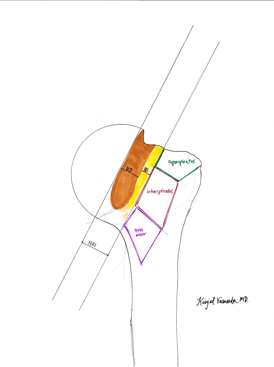 Hill-Sachs Interval
