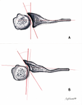 Type C Glenoids