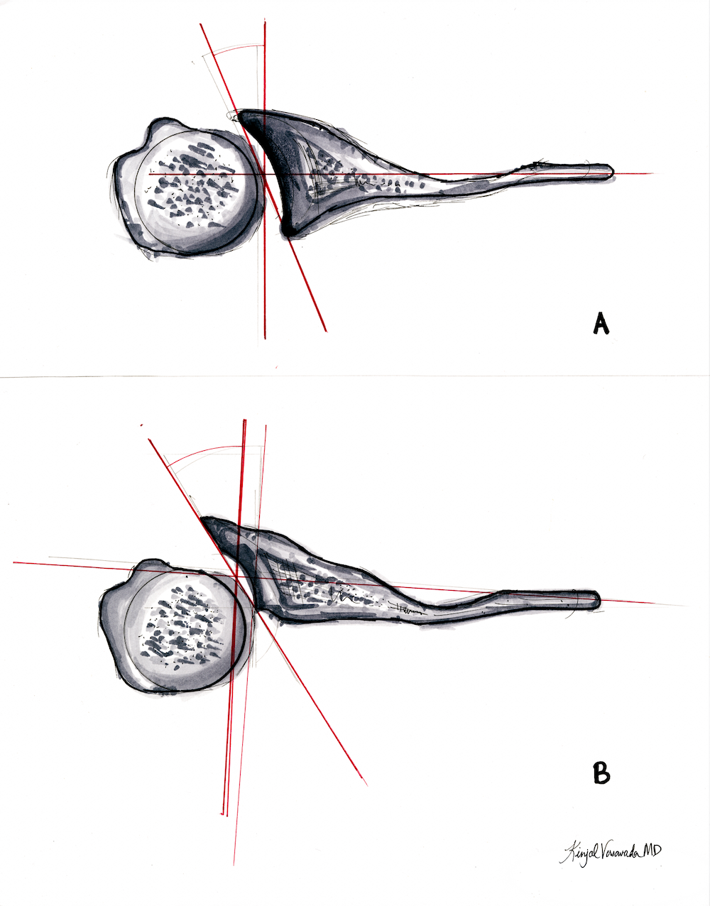 Type C Glenoids