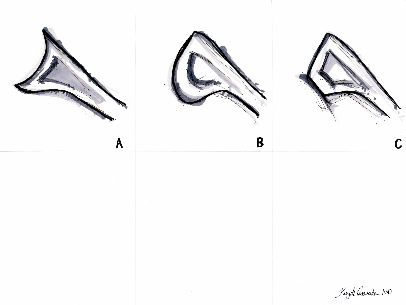 Normal and Dysplastic Glenoid Variants