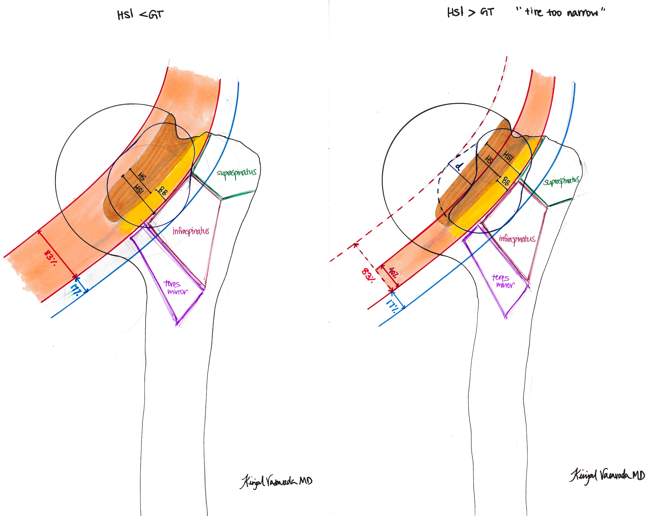 Hill-Sachs Interval Less Than or Greater Than Glenoid Track ("Tire Too Narrow")