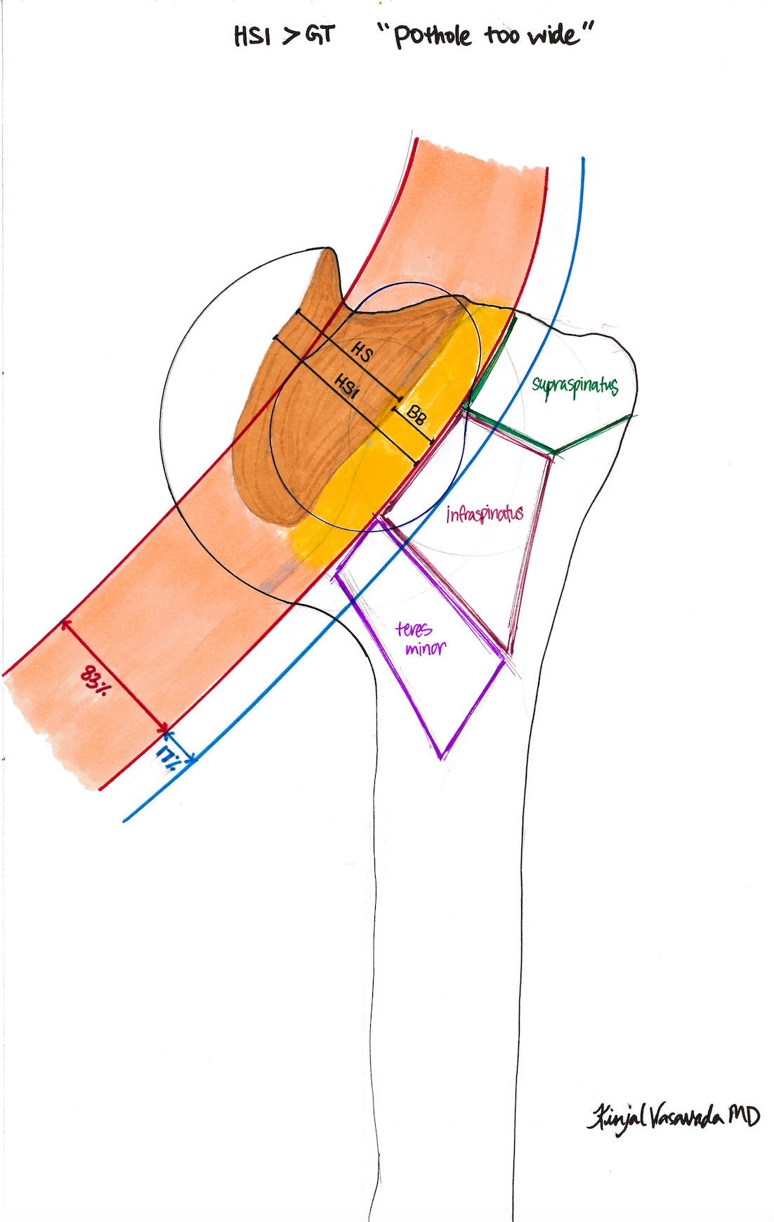 Hill-Sachs Interval "Off-Track"