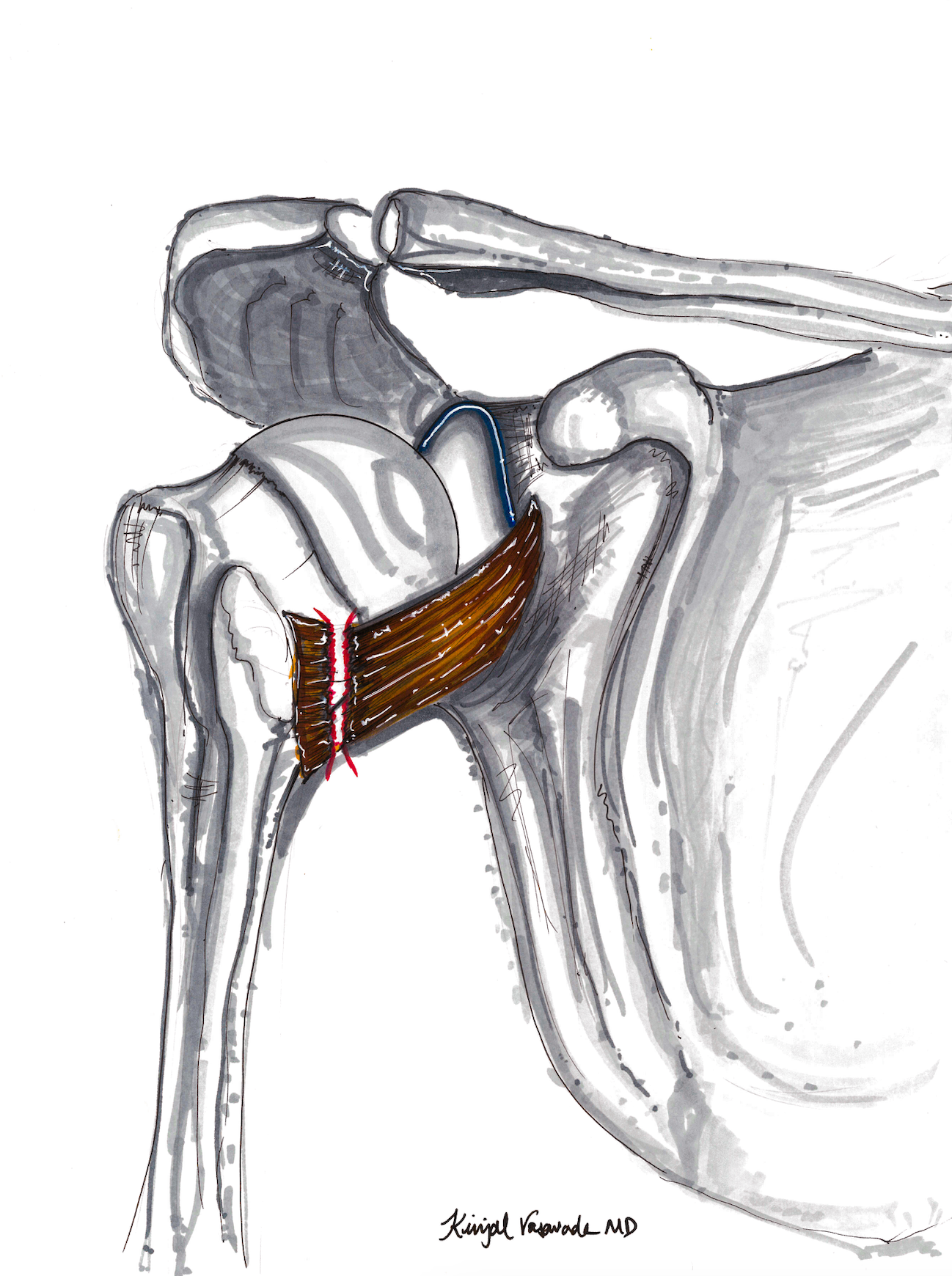Humeral Avulsion of Glenohumeral Ligament