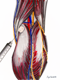 Bakers Cyst in Arthritic Knee
