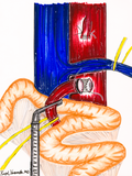 SMA Transposition 2