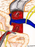 SMA Transposition 3